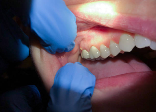 Best Emergency Dental Care for Broken or Chipped Teeth in Boronda, CA