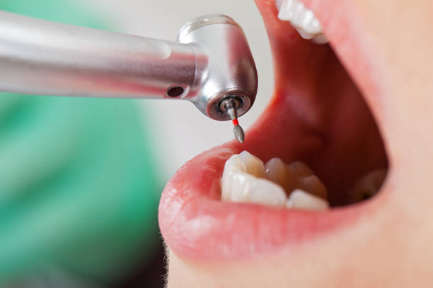 Best Emergency Wisdom Teeth Removal in Boronda, CA